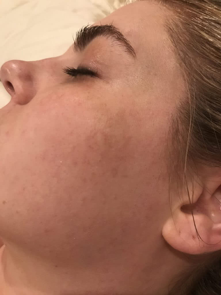 Dark spots and skin discoloration from Melasma