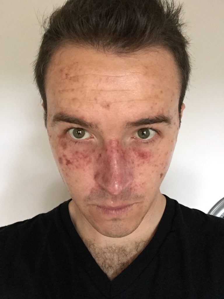 A man's skin after a Efudix treatment for skin cancer