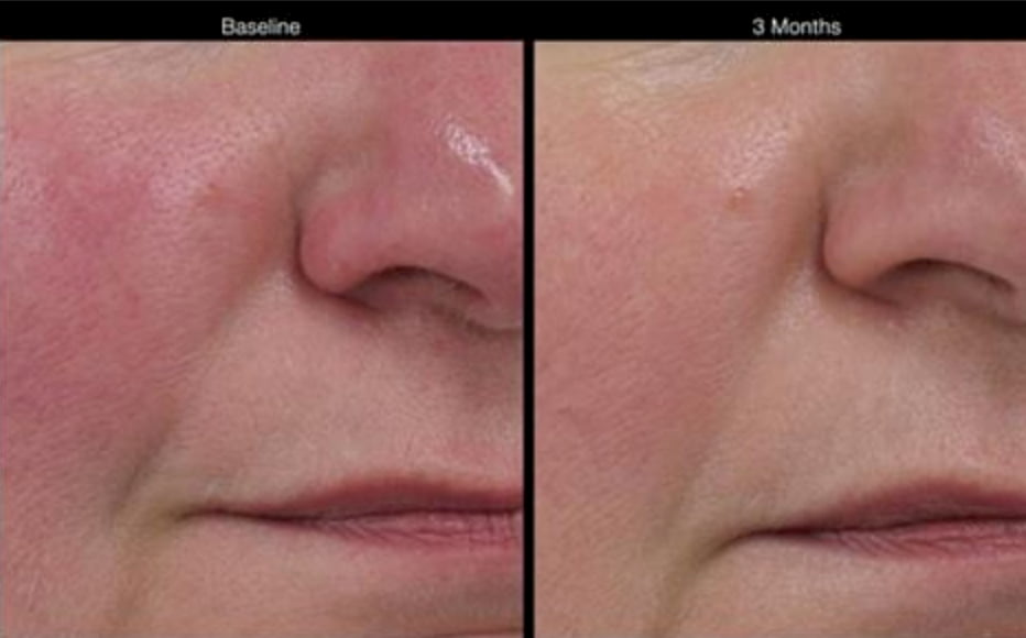 Before and after rosacea treatmenr